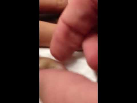 how to drain infected hangnail