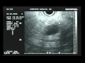 Pseudocyst In Pancreas, Endoscopic Ultrasound Pseudocyst In Pancreas, Endoscopic Ultrasound