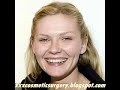 Cosmetic Celebs Before And After #10