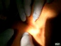 popping-a-massive-disgusting-cyst_1.mp4