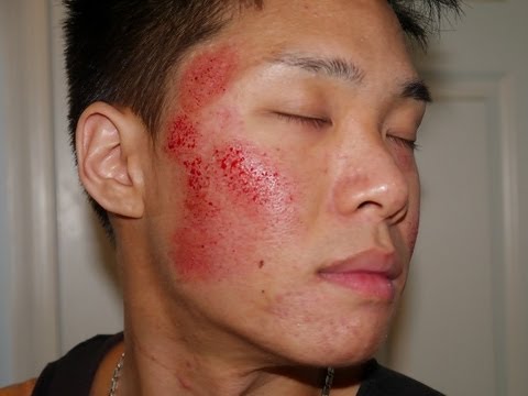 How to Treat Your Acne Scars at Home!