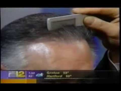 Dr. Ivan Cohen performs a hair ...