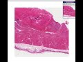 Histopathology Heart --Mural thrombus, infarct