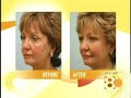 dallas-plastic-surgery-fat-grafting-face-lift-alternative.html