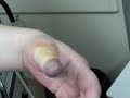 thumb full of lidocaine