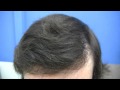 Hair Transplant by Dr Wong - 6121 Grafts - 2 Sessions