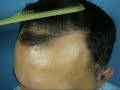Greg's 1200 graft hair transplant result