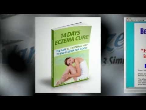 how to prevent eczema on hands