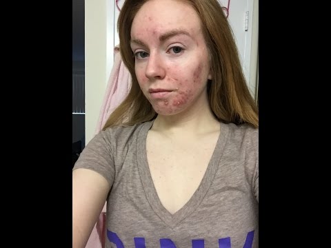 Acne Update | It's back and worse than ever!