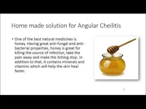how to cure angular cheilitis