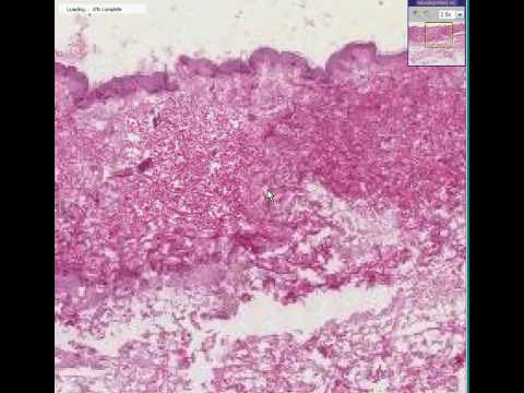 Histopathology Skin--Erysipelas