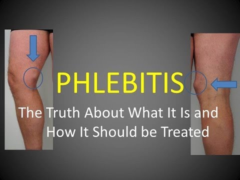 how to treat phlebitis