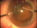 Capsular buttonhole