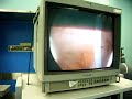 Endoclosure of  troca opening after laparoscopic surgery