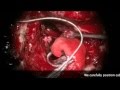 Translabyrinthine resection of neurofibromatosis type 2 associated vestibular and facial schwannomas