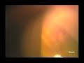 Argon Laser Peripheral Iridoplasty