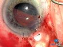 Suprachoroidal Haemorrhage Phaco 3.3 Complications
