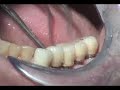 Replace lower molars