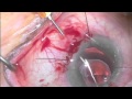 Scleral Lasso of dislocated Array Intraocular Lens with pars plana vitrectomy by Steven G. Safran MD