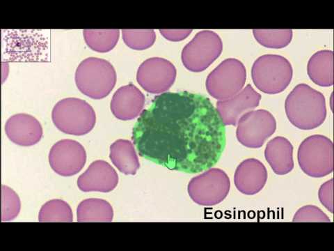 how to cure high eosinophils count