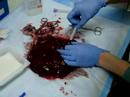 Tororo Placental Blood Collection_malaria pilot