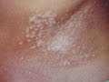 Lichen sclerosis Skin Findings