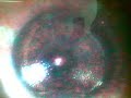 Oog laseren Fyeo