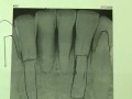 Implant Microsurgery Immediate Provisional Bridge