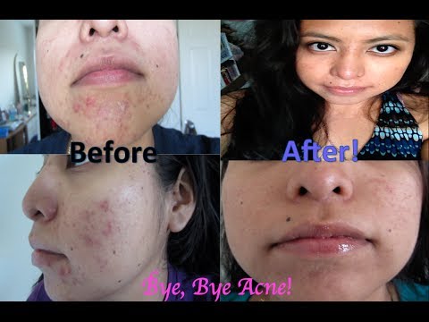 how to eliminate hormonal acne