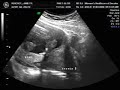 Judah verchot ultrasound