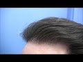 Hair Transplant NicNitro - Before and After - Dr Hasson Hair Transplant NicNitro - Before and After - Dr Hasson