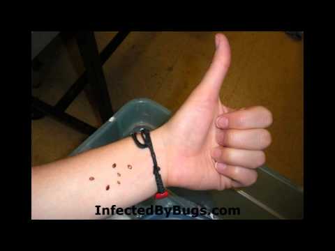 how to get rid of bed bugs uk