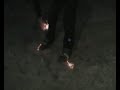 foot almost burnt off