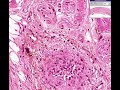 Histopathology Skin --Dry gangrene