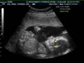 3D Sonogram @ 20 Weeks!