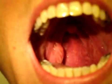 how to treat viral tonsillitis