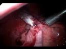 laparoscopy-appendicectomy-video-2-keyhole-lap-appendix.html