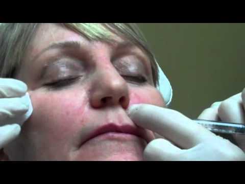 how to administer juvederm