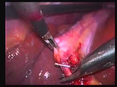 how to perform gallbladder surgery