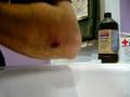 abscess