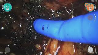 Robotic Total TVT Mesh removal