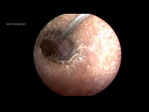 how to drain infected ear