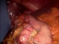 LapBand Removal Converted to Mini-Gastric Bypass LapBand Removal Converted to Mini-Gastric Bypass