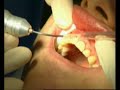 Laserbehandlung Parodontose Laserbehandlung Parodontose