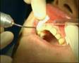 Laserbehandlung Parodontose