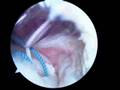 Arthroscopic Rotator Cuff Repair