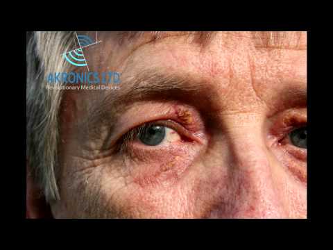 how to get rid of xanthelasma