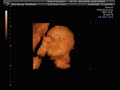 4D ultrasound at 29 weeks
