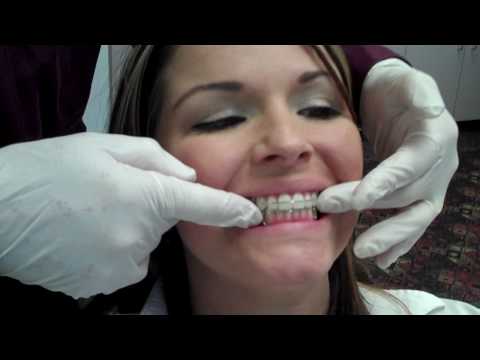 how to make retainers fit again