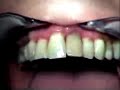 Immediate implantation and loading-Front tooth